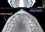 design dental splints in exocad ready for 3d printing